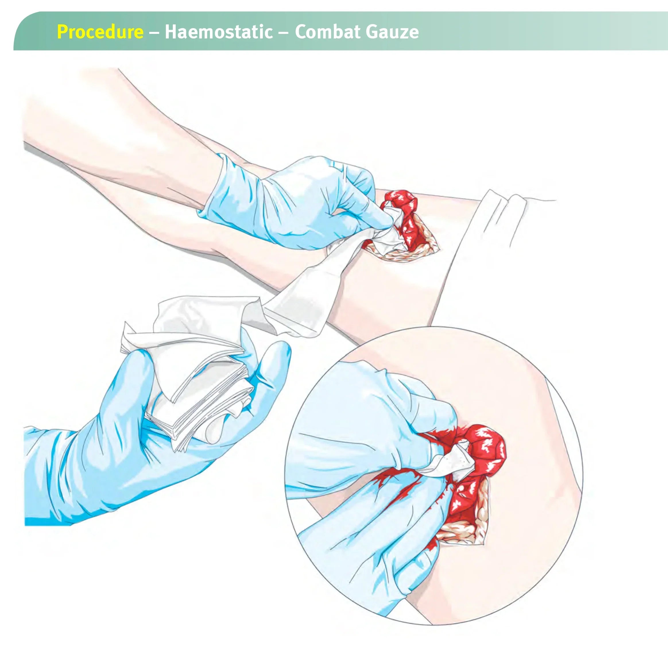 Rapid Clotting Hemostatic Gauze